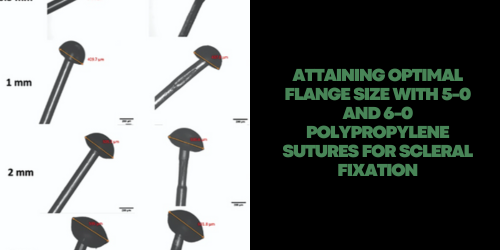 Attaining optimal flange size with 5-0 and 6-0 polypropylene sutures for scleral fixation
